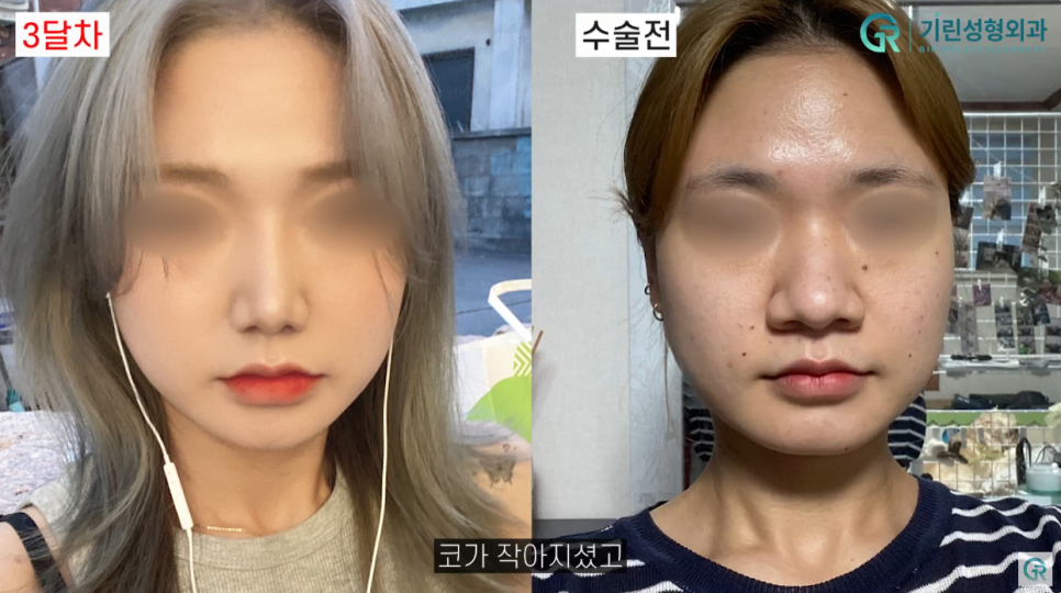 [기린성형외과의원] 코끝과 콧볼 교정으로 얄쌍해진 코_복코성형 수술일지 관련 이미지 5