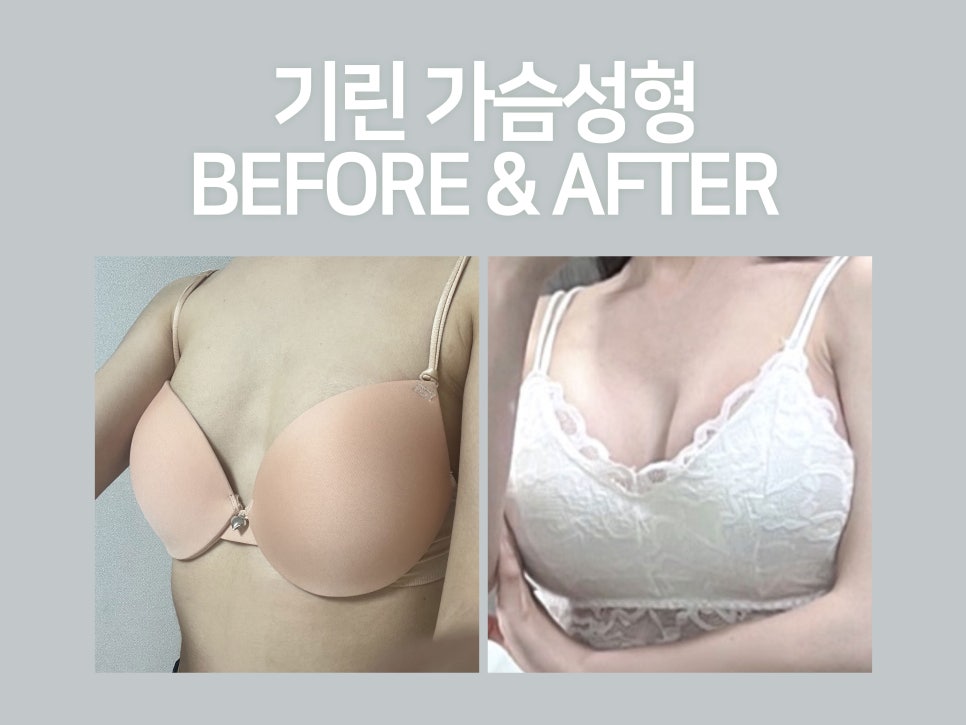 강남가슴성형 자연스러움이 기준 관련 이미지 2