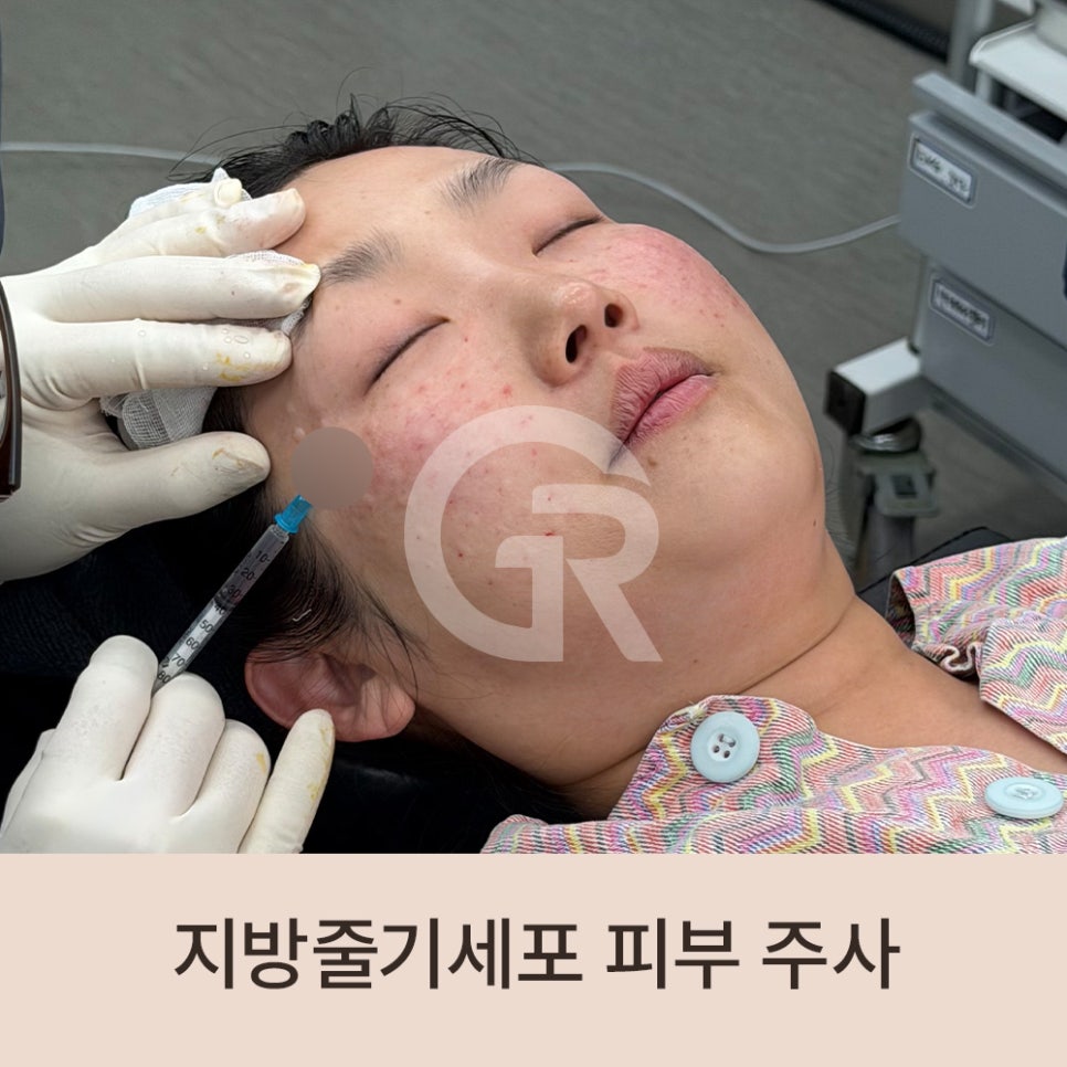 "머리숱이 없어요" 가르마 탈모 환자 줄기세포 주사 관련 이미지 7