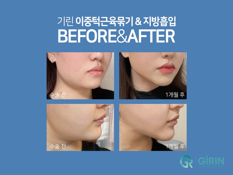 이중턱근육묶기 탄력 저하 잡아주는 관련 이미지 6