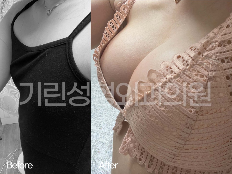가슴성형전후 비교가 필요하다면 관련 이미지 6
