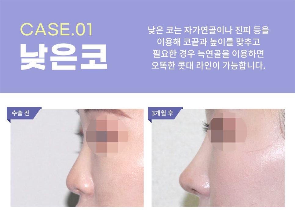 낮은코성형후기 차이점을 고려하여 관련 이미지 6