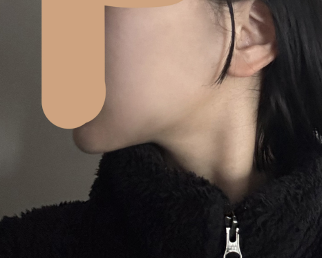 연조직윤곽술 후기, 볼살보다 신경 쓰였던 턱선 변화 관련 이미지 9