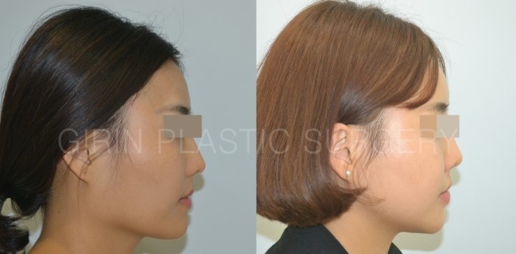 브이라인, 광대고정술 5개월경과 관련 이미지 3