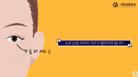 [기린성형외과] 어제보다 오늘 더 젊어지는 기린 이마거상_이마거상 Q&A 관련 이미지 4