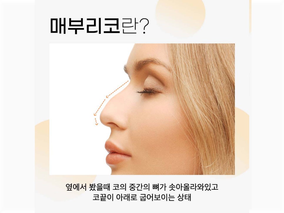 매부리코수술후기 올바른 라인으로 관련 이미지 4