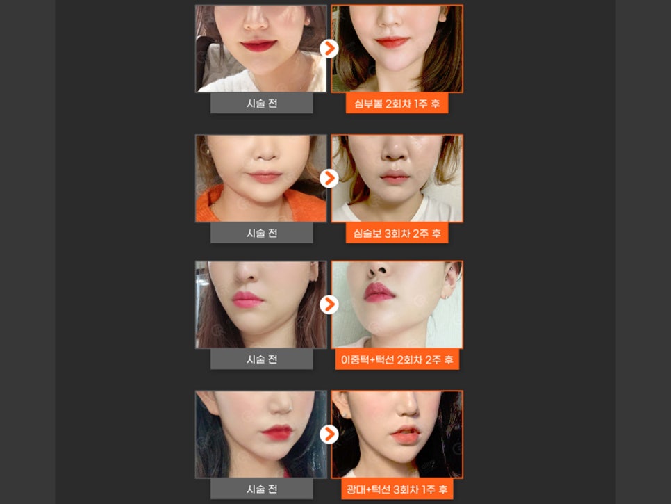 서울윤곽주사 잘하는 곳의 기준은 관련 이미지 11