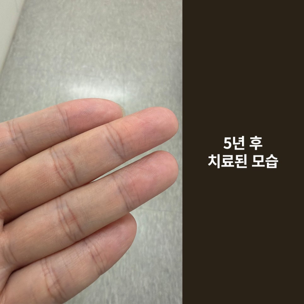 Girin Plastic Surgery for Finger Laceration Suturing, Skin Grafts, and Scar Care image 7