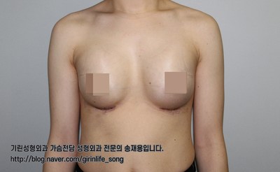 [가슴확대성형] 75A에서 75C로, 모티바 보형물을 이용한 가슴 확대 수술 케이스 관련 이미지 5