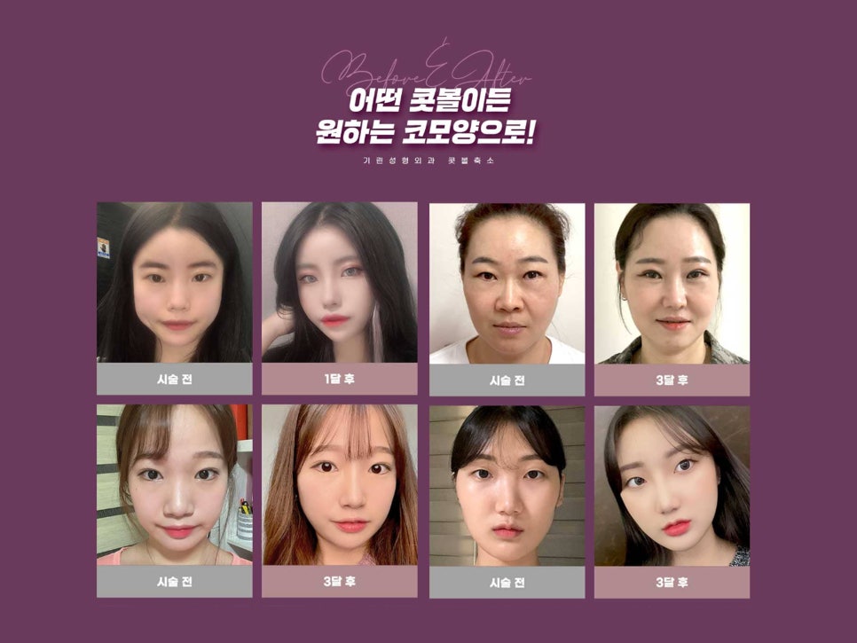 콧볼축소수술전후 얼마나 달라질까 관련 이미지 10