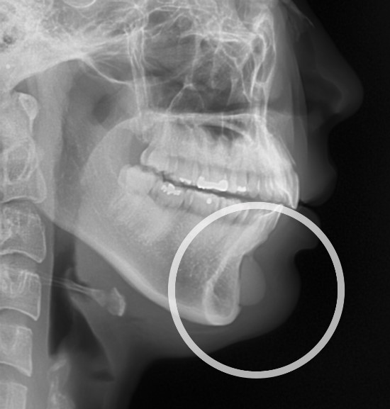 앞턱 보형물의 잘못된 위치로 인한 부작용증상 관련 이미지 1