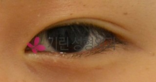 쌍꺼풀수술: 티안나는 쌍꺼풀수술 관련 이미지 4