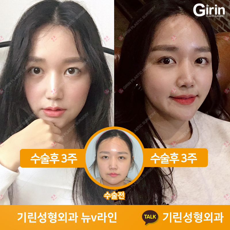 [뉴브이라인] 45도 라운딩 브이라인 절골술로 작은 얼굴 만들기 관련 이미지 6