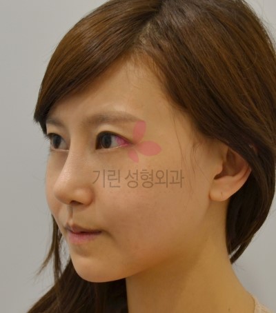 매부리코 성형의 시너지 귀족수술로 중안면부 볼륨주기 관련 이미지 2