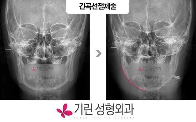 얼굴뼈(bone)+ 엑스레이 + 3DCT  사각턱수술 전후비교 관련 이미지 2