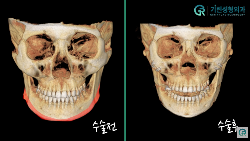 [기린성형외과의원] "카리나가 되고싶어요"_안면윤곽 수술일지 관련 이미지 7