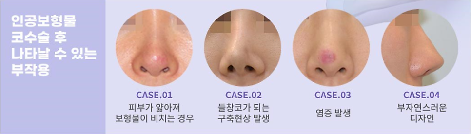 콧대높이기? 관련 이미지 5