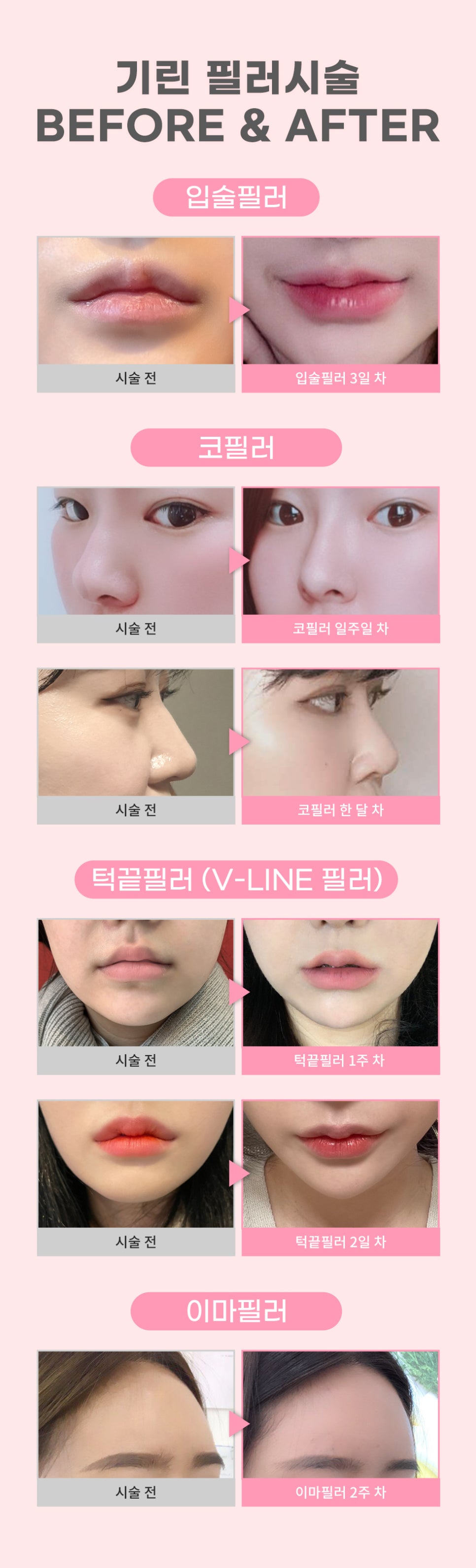 임보라가 선택한 안전한 필러, 에피티크 필러 알아보기! 관련 이미지 6