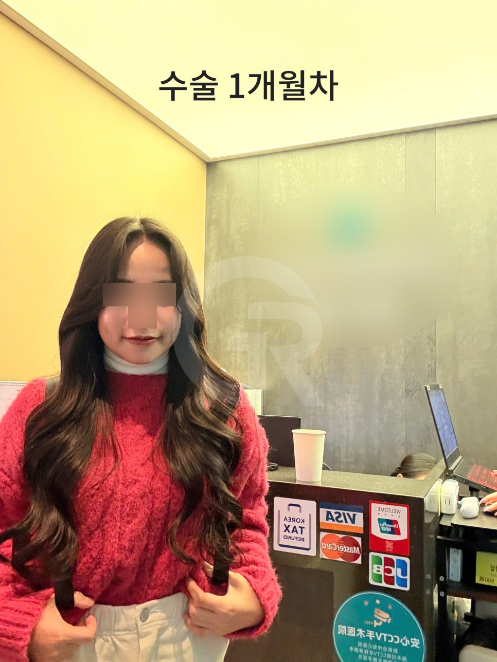 연조직윤곽술, 시간이 지날수록 자연스러운 얼굴선 관련 이미지 3