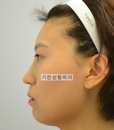 귀족수술과 코수술병행 시 중안면부 볼륨효과 관련 이미지 1