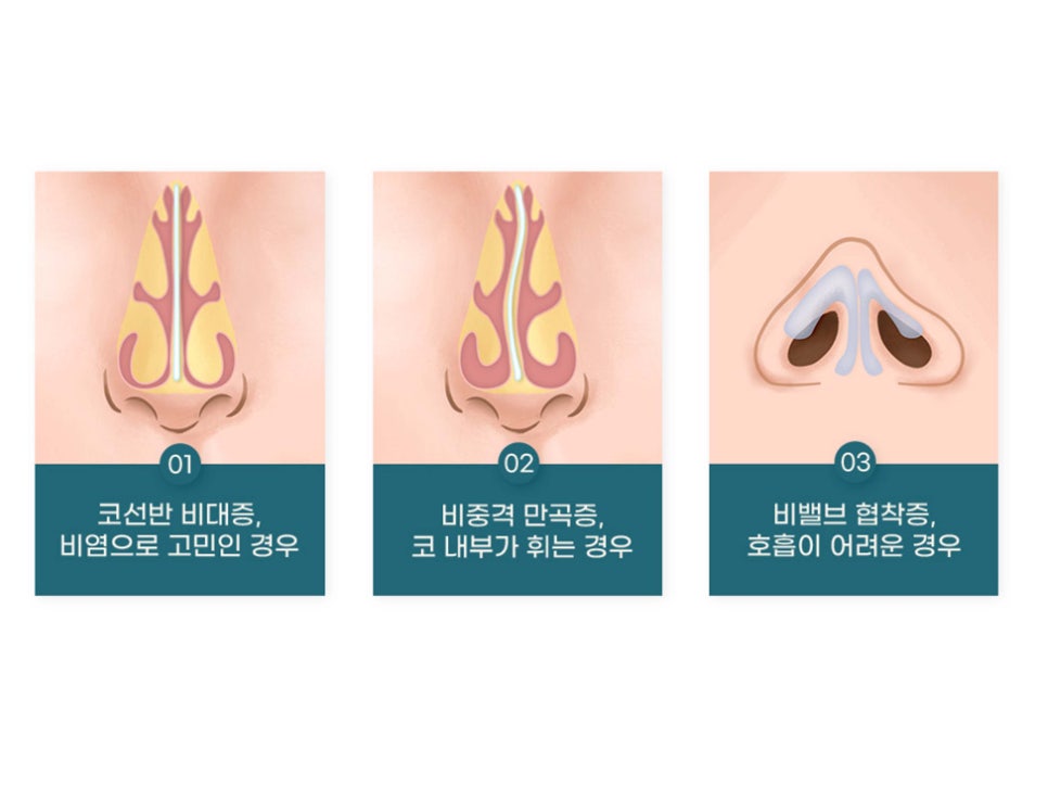 강남기능코성형 원인과 필요성 생각하여 관련 이미지 5