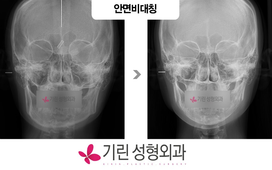 안면비대칭 전후 엑스레이 관련 이미지 1