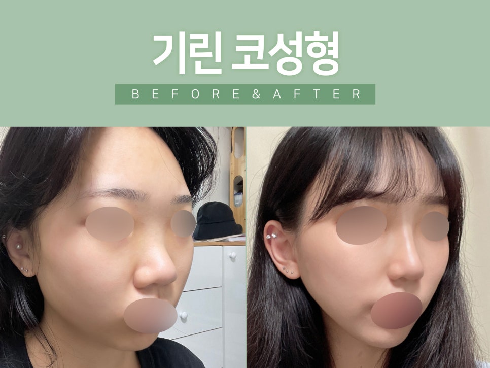 낮은코수술 원하는 라인으로 관련 이미지 3