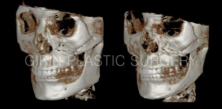 광대재수술+브이라인 전후 관련 이미지 2