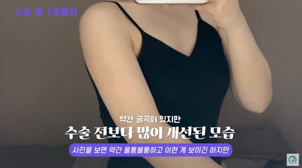 [기린성형외과] 뼈 팔뚝 된 비결 알려줄게_팔뚝 지방흡입 수술일지 관련 이미지 10