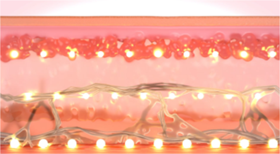 내 피부에 꼭 맞는 리프팅, 퍼스널울쎄라 관련 이미지 3