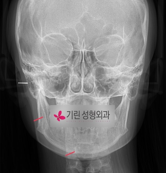 사각턱수술case (귀밑사각 부터 앞턱끝까지) 관련 이미지 1
