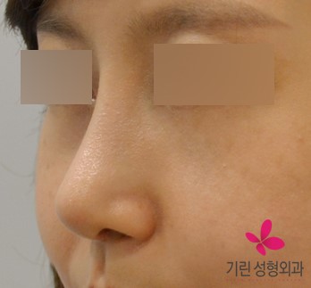매부리코(+화살코)수술과 귀족수술을 같이 한 경우 관련 이미지 2