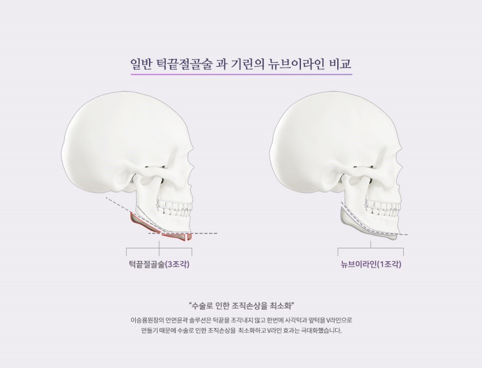 [뉴브이라인]45도 라운딩 브이라인 절골술로 작은 얼굴 만들기 관련 이미지 3