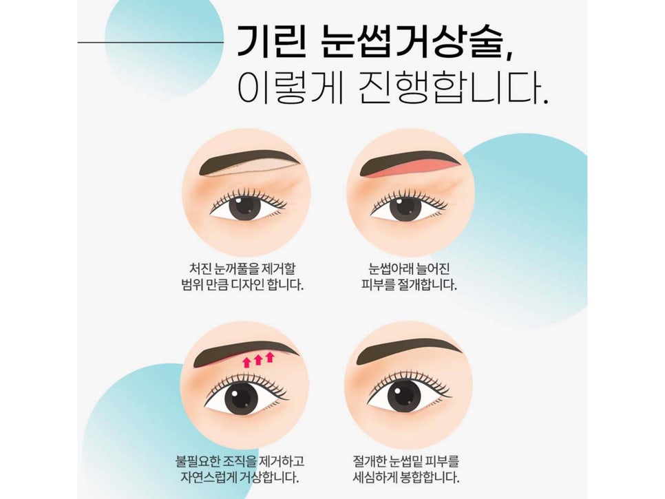 눈썹거상술흉터 걱정하고 있었다면 관련 이미지 6