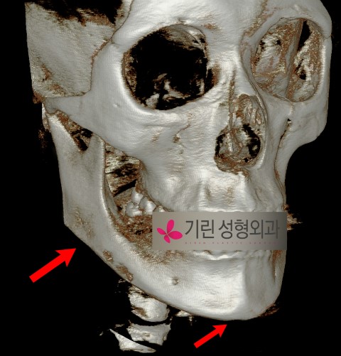 효과미비로 인한 사각턱재수술사례 관련 이미지 2