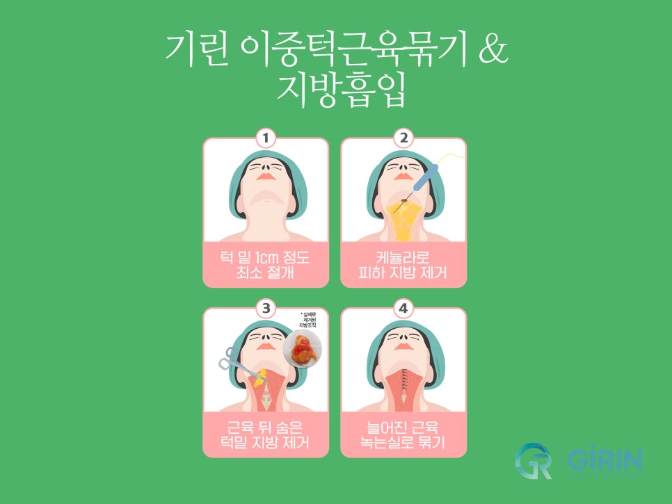 이중턱수술 확실히 효과 보려면 관련 이미지 6