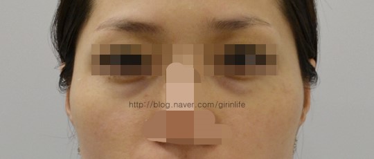 옆광대뼈축소 2달차 붓기정도(B&A) 관련 이미지 1