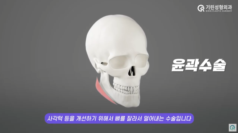 [기린성형외과의원] 얼굴뼈수술 전 필수 시청_초간단 양악수술 자가진단법 관련 이미지 4