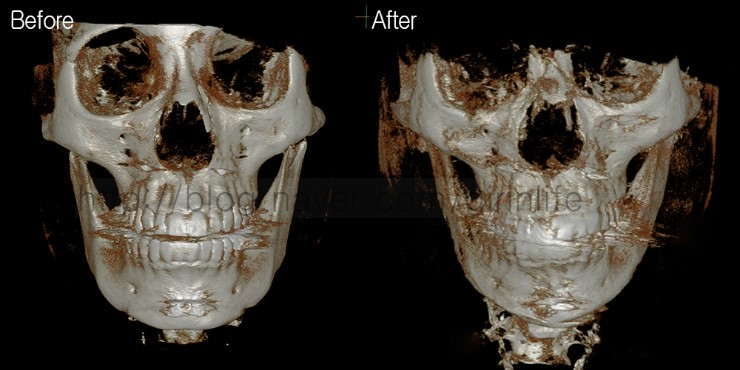 사각+앞턱을 했지만 효과가 떨어지는 경우 재수술사례 관련 이미지 1