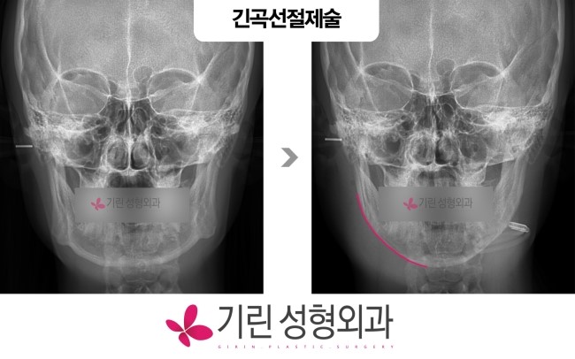 기린성형외과 긴곡선절제술 후 절골된 뼈(bone) 관련 이미지 2