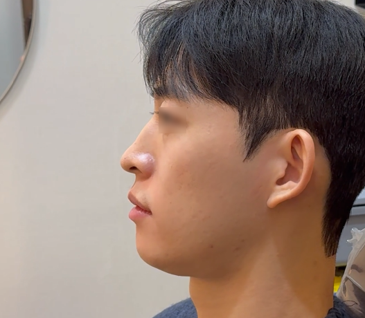 남자 미니젤리코 사례로 보는 코시술 후기 관련 이미지 1