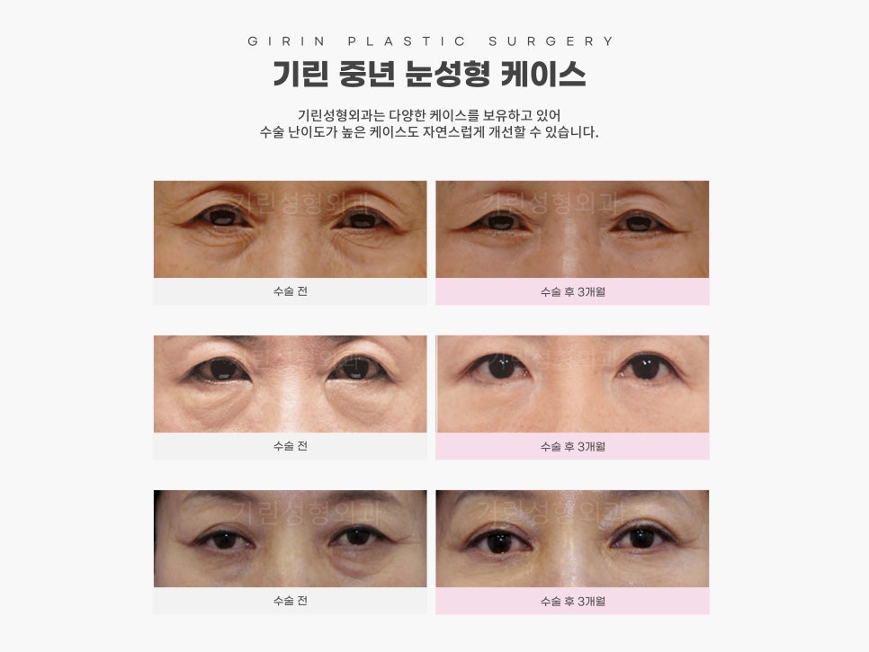 중년눈수술 어려지는 방법 중 하나? 관련 이미지 13