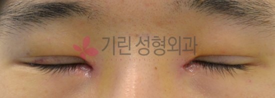 쌍꺼풀수술후기 : 일주일 경과 쌍꺼풀전후 관련 이미지 2