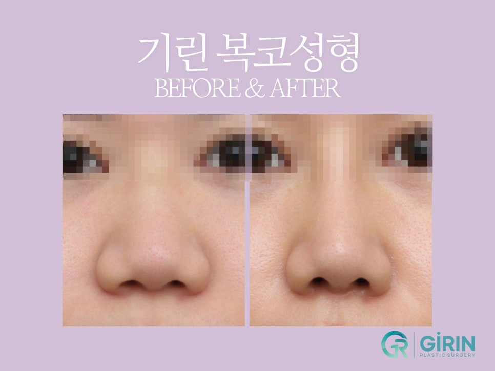 복코성형후기 세련미 있는 코 원한다면 관련 이미지 6