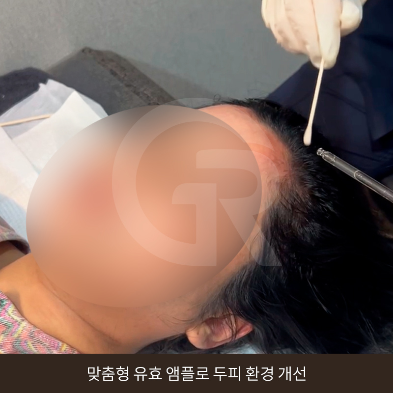 탈모 고민 두피 줄기세포 치료, 가격이 다른 이유는? 관련 이미지 11