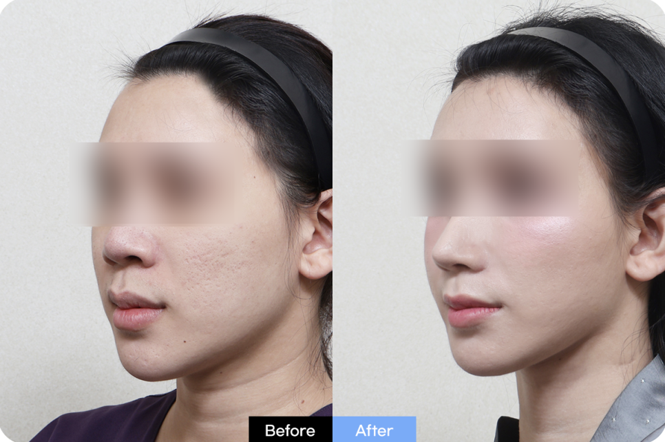 비익거상, 코수술할 때 처진 콧볼을 함께 보는 이유 관련 이미지 3