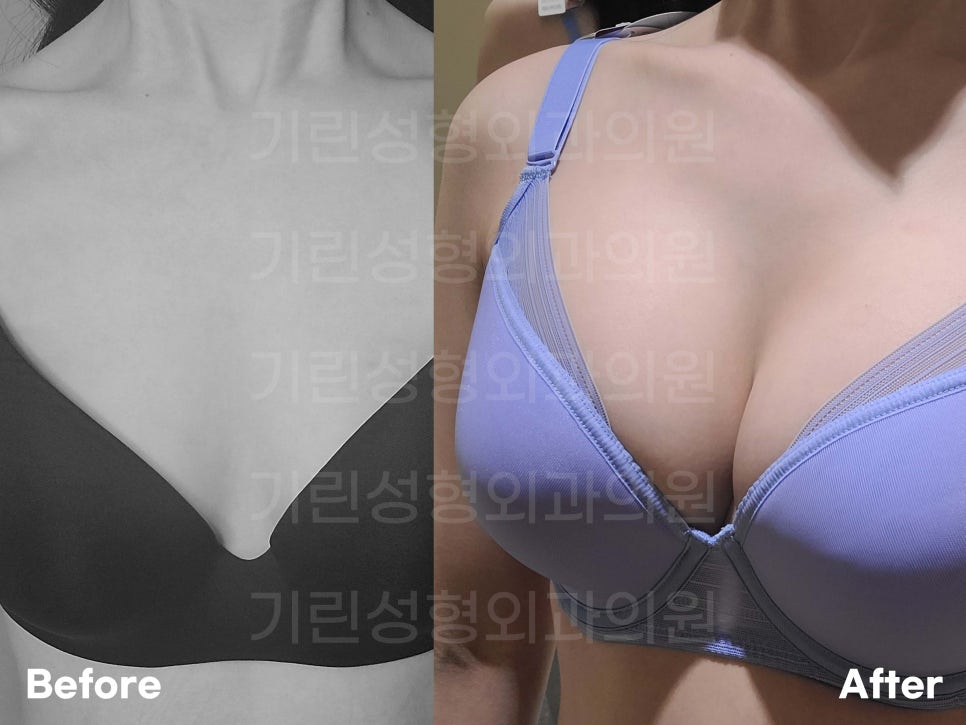 가슴확대수술전후 개선한 모습 궁금하다면 관련 이미지 10