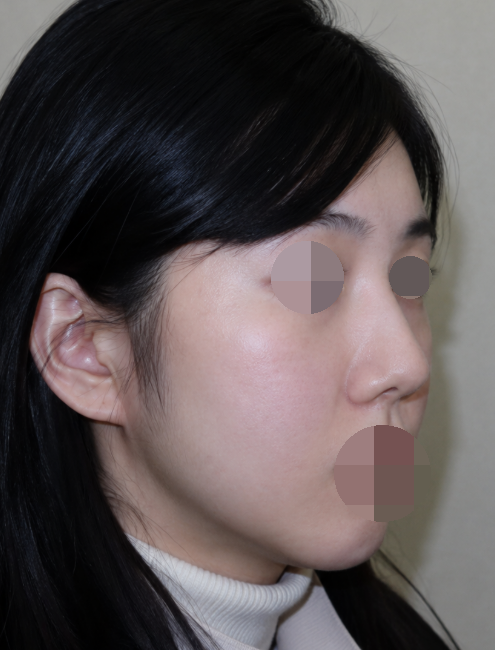 Features of Recently Preferred Facial Shapes, as Seen by a Soft-Tissue Contouring Specialist image 4