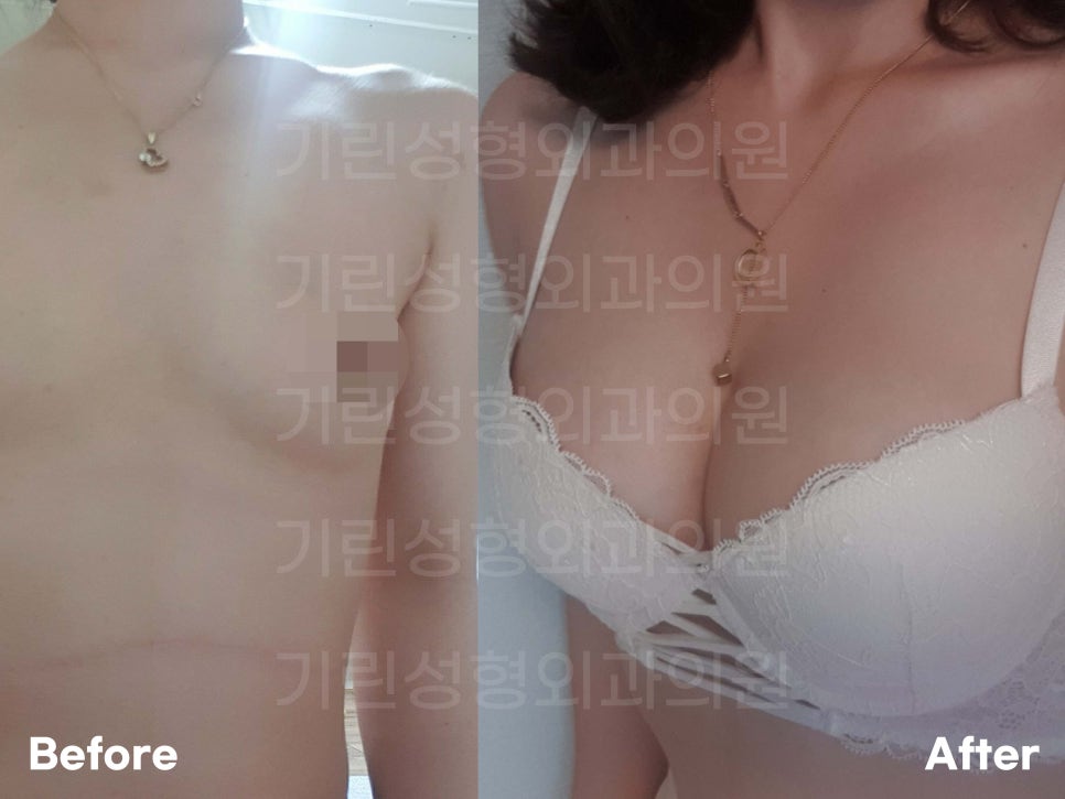 멘토가슴성형 차이를 알고 선택해야 관련 이미지 1