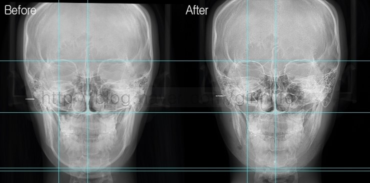 긴곡선절골로 앞턱길이를 함께 줄인 경우 관련 이미지 7